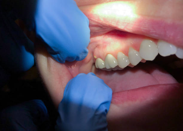 Best Emergency Dental Extractions in Imlay City, MI